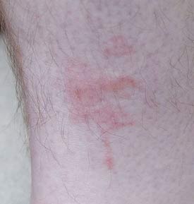 Image of a man's ankle with numerous swollen bed bug bites.